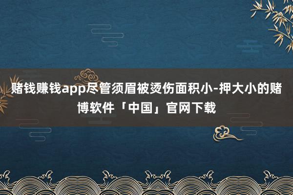 赌钱赚钱app尽管须眉被烫伤面积小-押大小的赌博软件「中国」官网下载